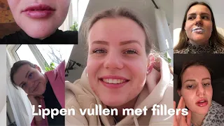 VOOR HET EERST MIJN LIPPEN LATEN DOEN 💉  RESULTAAT NA 1 WEEK 👄 ★ Jemaine Joseline