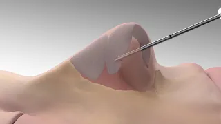 LATERA Animation for Patients