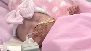 UK Baby Born With Heart Outside Body Survives Surgery
