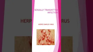 GYNECOLOGY, SEXUALLY TRANSMITTED INFECTION, HERPES SIMPLEX VIRUS(HSV)