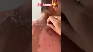 Sun burn 🔥