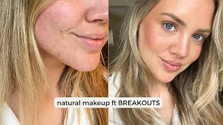 Summer Skin FT Breakouts | Elanna Pecherle 2022