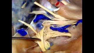 Cavernous Sinus and Middle Fossa - Part 1 of 2