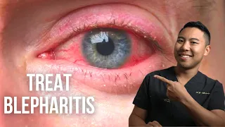 How to treat blepharitis (3 Science-Backed Ways) | Ophthalmologist@MichaelRChuaMD