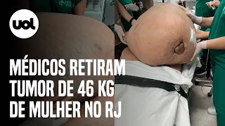 Mulher tem tumor de 46 kg retirado em cirurgia de emergência no RJ