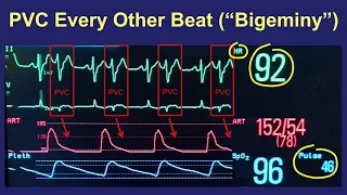 Patient education video titled: PVCs: Symptoms and Treatment - in Plain English