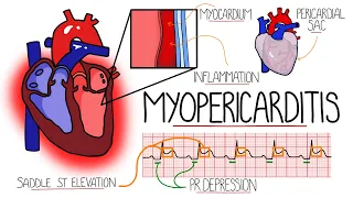 Myocarditis & Pericarditis (Myopericarditis Explained)