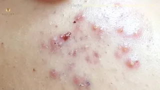 Blackheads on chin, Extraction cyst with hien van spa-430-Khánh Ngân