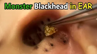 Monster Blackhead in Ear