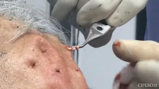 Steatocystoma Multiplex Removal - Forehead