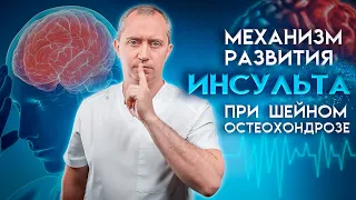 Механизм развития инсульта при шейном остеохондрозе