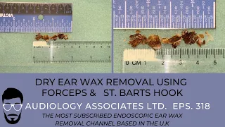 DRY EAR WAX REMOVAL USING FORCEPS AND ST BARTS HOOK - EP318