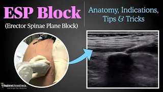 Erector Spinae Plane (ESP) Block