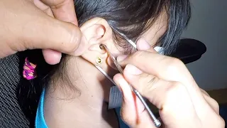 Girl's HUGE Earwax Removal | How to Remove Earwax Using An Ear Curette