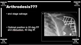 Shoulder Arthritis w/ Dr. Garrigues