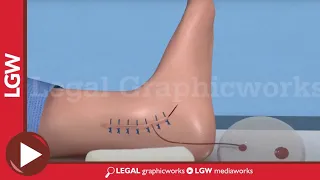 Ankle Drain surgery 3D animation