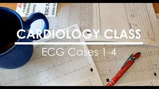 ECG - STEMI inferiore, fibrillazione atriale, disturbi di conduzione e ipertrofia ventricolare