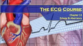 The ECG Course - Ectopy & Aberrancy