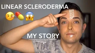 Linear Scleroderma, En Coup De Sabre - My Story