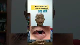 Konjungtivitis (Mata Belekan)| dr. Basuki Rokhmad