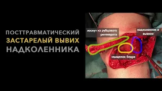 Посттравматический застарелый вывих надколенника (реконструкция по авторской методике).