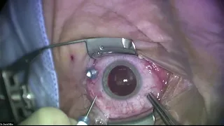 Surgery: Live Surgical Demonstration: Basics of Macular Hole Surgery