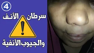 العلامات التحذيرية لسرطان الأنف والجيوب الأنفية