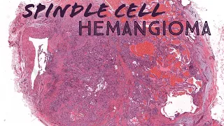 Spindle cell hemangioma (AIP France 2021 - bonus case) dermpath dermatology pathology