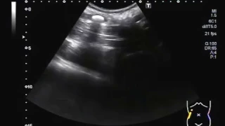 Ultrasound Video showing scanning of Ureteric stone with different body positions and Probes