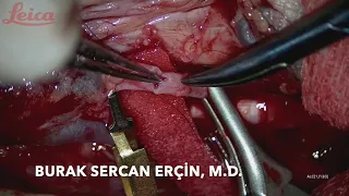end to end venous anastomosis - backwall first technique (background sponge assisted)