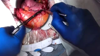 Pancreaticojejunal Anastomosis (Training Case)