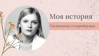 Моя история: Анастасия Лазарева о жизни с системной склеродермией