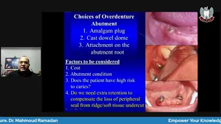 Tooth Supported Overdenture Part 3: Treatment planning and clinical procedures