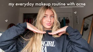 my everyday makeup routine with acne (while on accutane!)