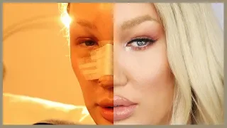 Transitioning | Facial Feminization Surgery | Alexis Stone