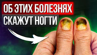 Что сообщают НОГТИ о нашем ЗДОРОВЬЕ? / Как ногти могут указывать на проблемы в организме?