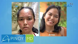 Pinoy MD: Mabisang pangtanggal ng cystic acne, alamin!