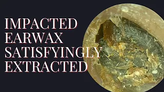 Impacted Earwax Satisfyingly Extracted