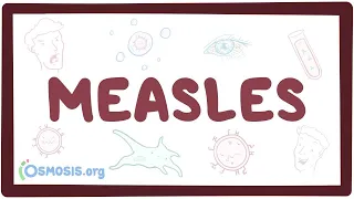 Measles - causes, symptoms, diagnosis, treatment, pathology