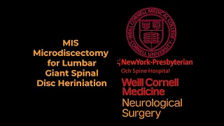 MIS Microdiscectomy for Lumbar Giant Spinal Disc Heriniation