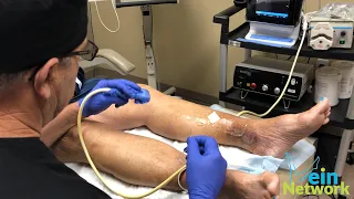 What is ultrasound guided sclerotherapy?