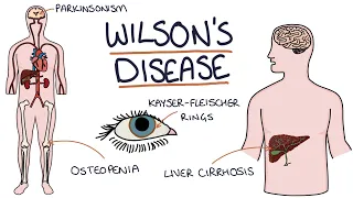 Understanding Wilson's Disease