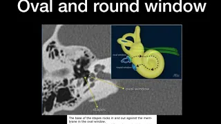 CT temporal bone -Basic anatomy Simplified