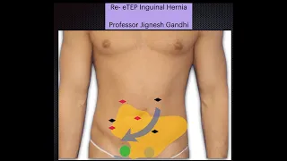 Re eTEP for Inguinal Hernia