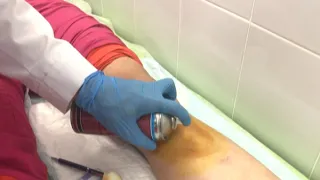 PRP периартикулярная инъекция в "гусиную лапку" коленного сустава