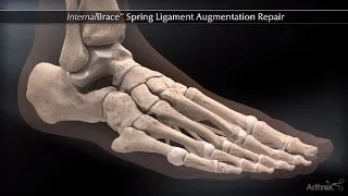 InternalBrace™ Spring Ligament Augmentation Repair