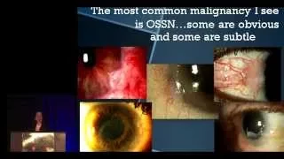 Dra  Carol Karp - Conjunctival Tumors : What´s new