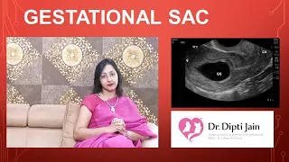 GESTATIONAL SAC what's normal and what's abnormal