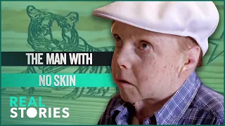 Jonny Kennedy: The Man Whose Skin Fell Off (BAFTA-AWARD WINNING DOCUMENTARY) | Real Stories