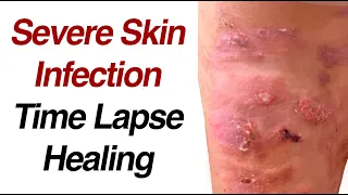 Severe Skin Infection Healing Time Lapse: Impetigo to Cellulitis to Resolution (0 to 30 days)